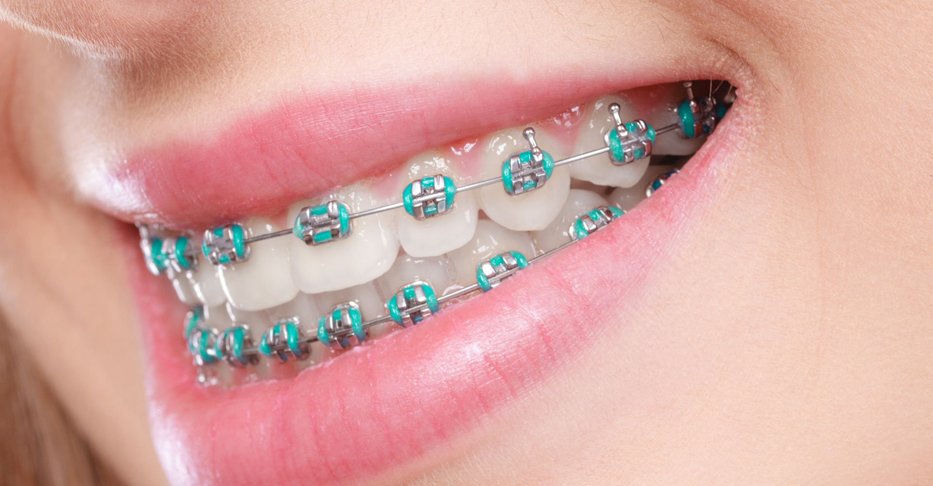 Damon Brackets vs Invisalign: Which is Best for Your Smile?