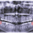 wisdom tooth