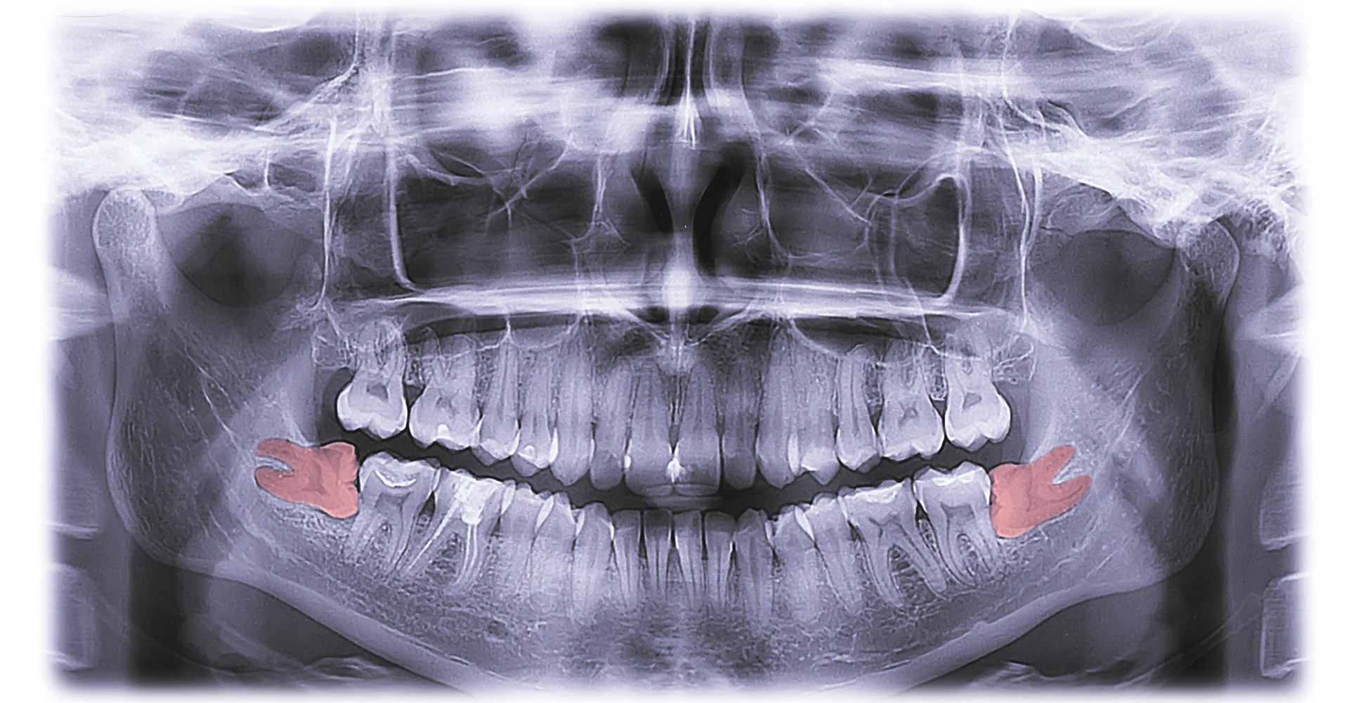 Can Wisdom Teeth Shift Your Teeth After Braces?